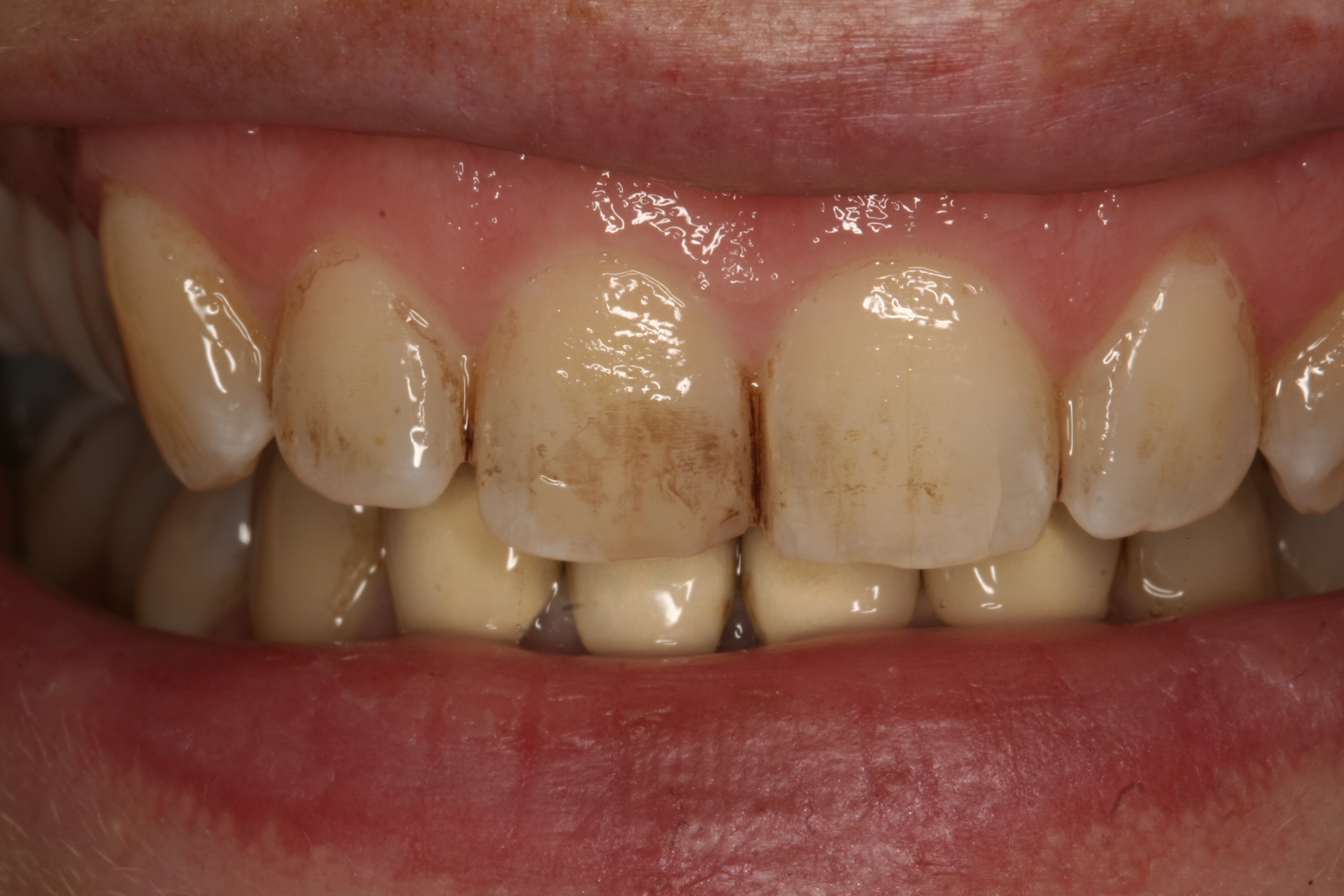 Air Polishing Avenue Road Dental