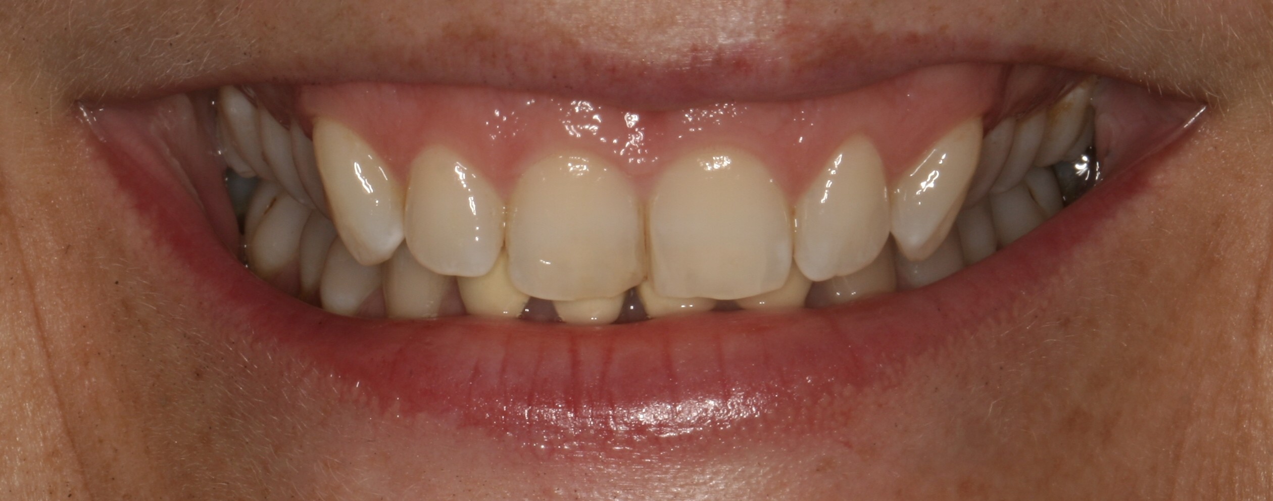 Air Polishing Avenue Road Dental